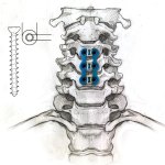 Anterior-C-Plate Anterior-C-Plate