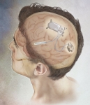 NeuroPace-Devise NeuroPace-Devise