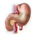 Superior-Mesenteric-Artery-Syndrome Superior-Mesenteric-Artery-Syndrome