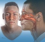 Upper-Airway-Disorders Upper-Airway-Disorders