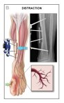 1_B-Tibial-Procedure