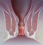 Anal Fissure Anal Fissure
