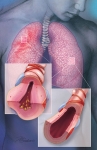 Asthma Asthma