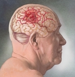 Brain Tumor Brain Tumor