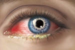 Conjunctivitis Conjunctivitis