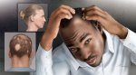 Hair Loss Hair Loss