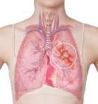 Lung-Disease