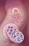 Polycystic Ovary Syndrome Polycystic Ovary Syndrome
