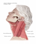 Cervical-Dystonia