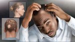 Hair-Loss Hair-Loss