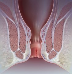Anal Fissure