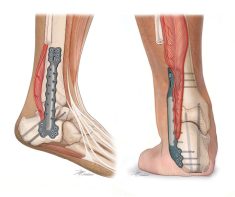 Ankle-Fusions
