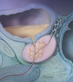Prostate Cancer