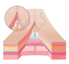 Skin Closure Technique