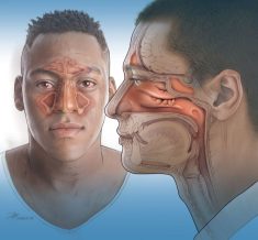 Upper-Airway-Disorders
