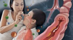 Pediatric Asthma